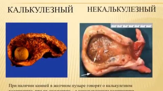 Заболевания желчного пузыря.Биокоррекция продукцией Линейки Диэнай смотреть онлайн