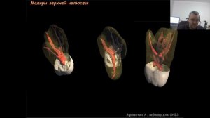Вебинар №3 - Частная анатомия корневых каналов.