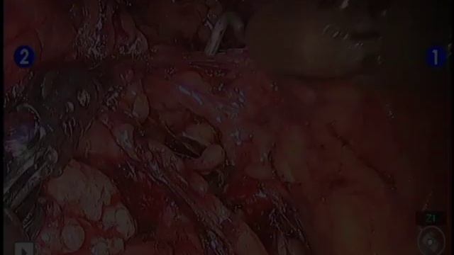 Internal Iliac Pelvic Lymph Node Dissection during Robotic Prostatectomy смотреть онлайн