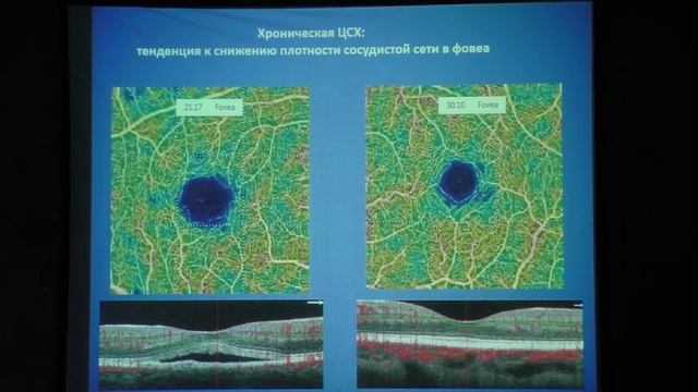 Сосудистые изменения в сетчатке при центральной серозной хориоретинопатии Докладчик Федорук Н.А. смотреть онлайн
