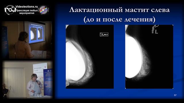 20160325 маммология смотреть онлайн