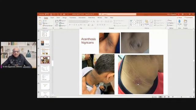 Covid 19 FAQ 281: Acanthosis nigricans A Marker of Inflammation and Insulin Resistance смотреть онлайн