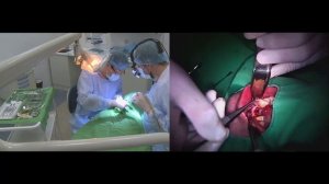 Пластика кости и мягких тканей в дентальной имплантологии
