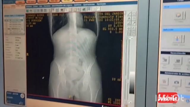 COMO REALIZAR UNA TOMOGRAFÍA DE ABDOMEN CON MEDIO DE CONTRASTE. смотреть онлайн