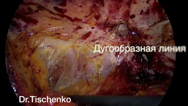 TAPP пластика пупочной грыжи.