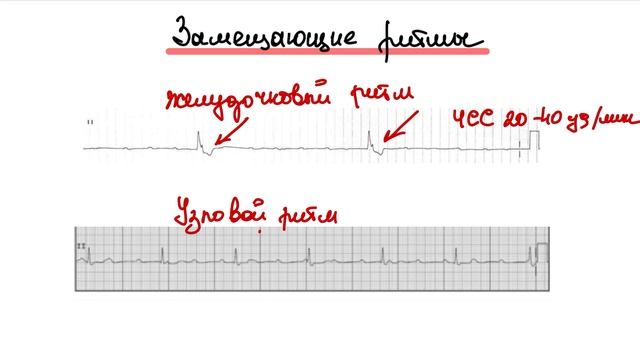 Красные флаги на ЭКГ. Жизнеугрожающие состояния. Особенности ЭКГ. смотреть онлайн