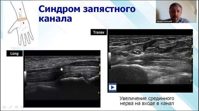Возможности УЗИ в диагностике нетипичных вариантов туннельных невропатий. смотреть онлайн