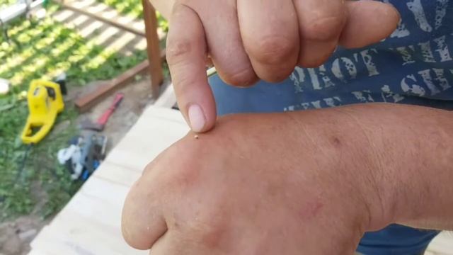 Как правильно удалить пчелиное жало после укуса смотреть онлайн