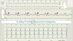 Урок 3 - «Синусовая тахикардия»