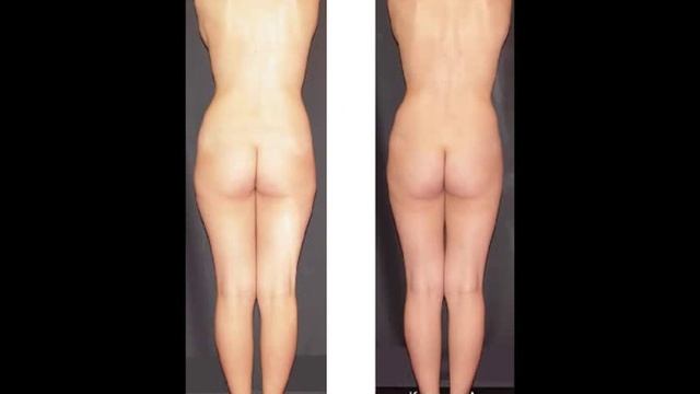 ПОПИНЫ УШИ КАК УБРАТЬ ? смотреть онлайн