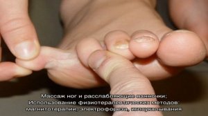 Неврома Мортона стопы