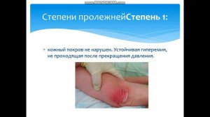 "Пролежни. Стадии.Уход и профилактика". Онлайн урок