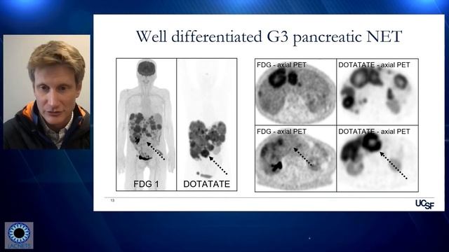 10. The Latest in NET Imaging & PRRT (Dr. Thomas Hope) смотреть онлайн