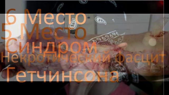 Топ 10 Самых страшных болезней! смотреть онлайн