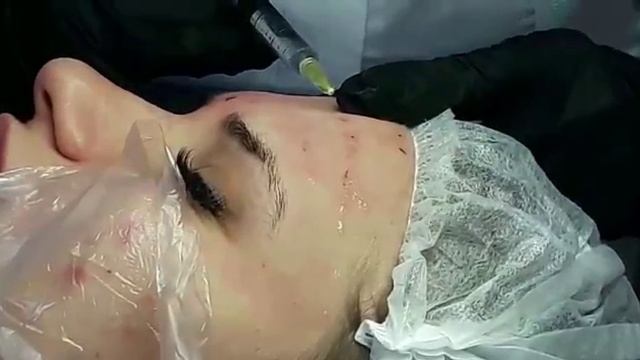 Аириском: студенты учатся. Практика ученика по МЕЗОТЕРОПИИ. Коктейль ГК и DMAE смотреть онлайн