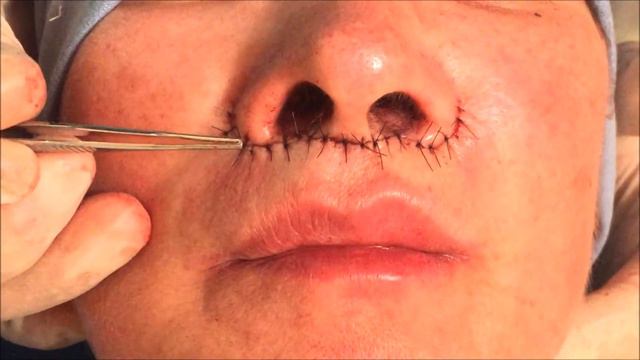 Nasal Lip Lift o Cheiloplastica Modificata смотреть онлайн