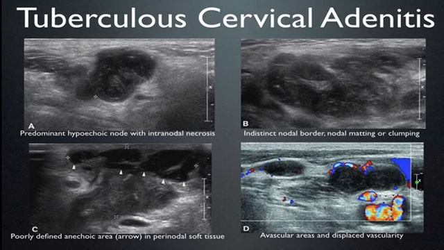 Secrets of the Lowly Lymphnode смотреть онлайн