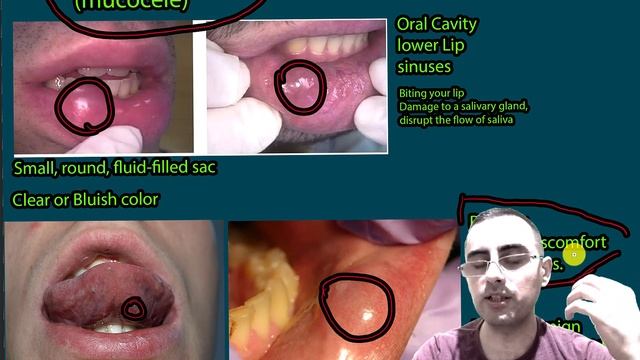 Bump in the mouth: Mucocele, Submucosal Cysts, signs, symptoms and treatment смотреть онлайн