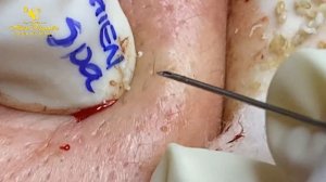 Satisfying video with Hien Nguyen Spa Beauty #007