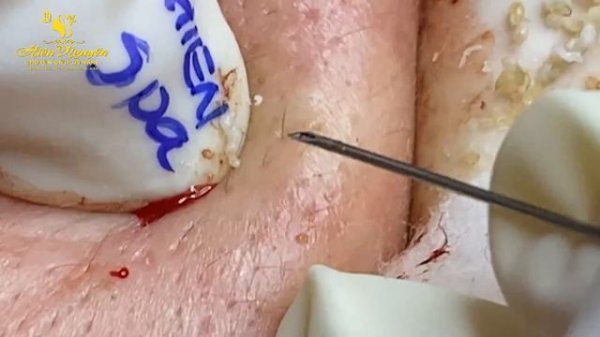 Satisfying video with Hien Nguyen Spa Beauty #007