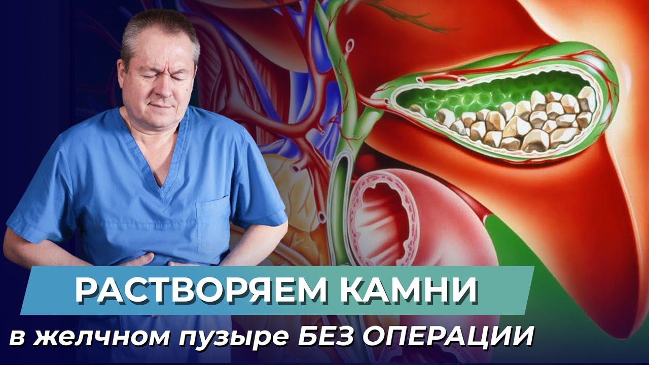 Как удалить камни в желчном пузыре? Профилактика образования камней в желчном пузыре смотреть онлайн