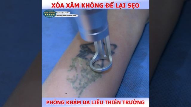 XÓA XĂM KHÔNG ĐAU KHÔNG ĐỂ LẠI SẸO TẠI THIÊN TRƯỜNG смотреть онлайн