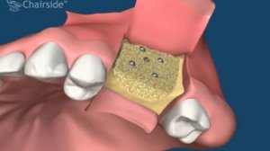 Наращивание костной ткани   Направленная костная регенерация НКР и установка имплантатов и коронок