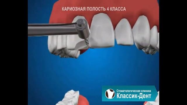 Классик-Дент: Кариозная полость 4й класс смотреть онлайн