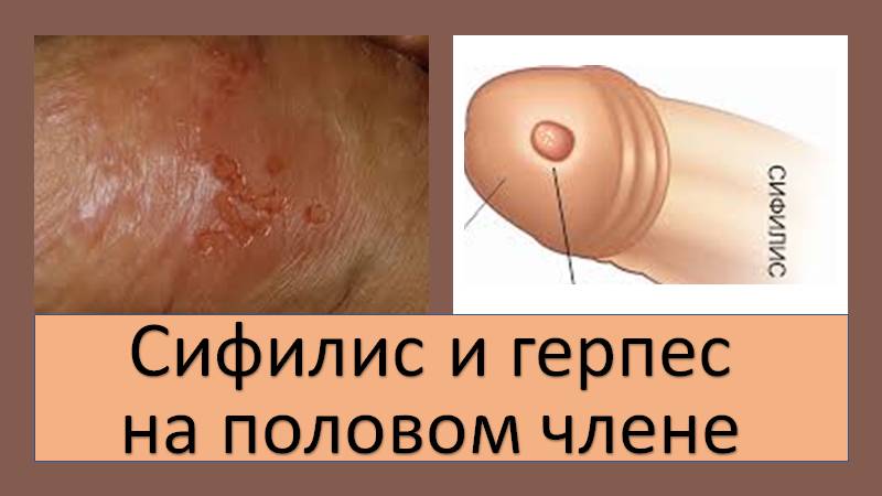 Сифилис и герпес на половом члене смотреть онлайн