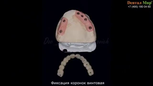 Установка имплантатов, коронки на имплантаты, имплантация после удаления, навигационные шаблоны. смотреть онлайн