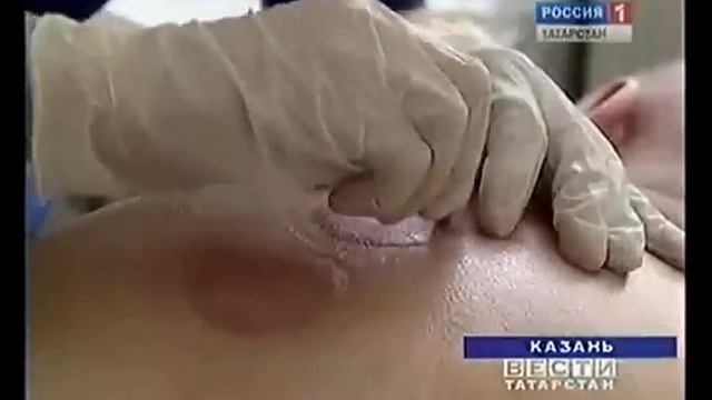 Хиджама, точки хиджамы смотреть онлайн