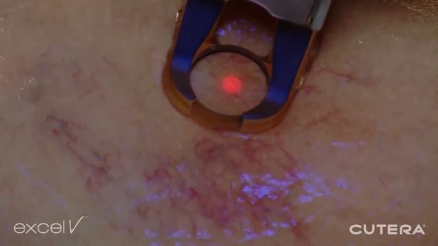 See the Excel V in Action Treating Leg Veins смотреть онлайн