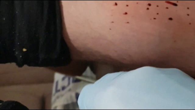 Хиджама сунна пророка Мухьаммада  Мир и благословение Аллах1а Ему. Sunnah. Hijama  çukurluğu  الحجا