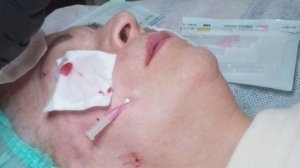 НИТИ SCREW. Носогубная складка /периоральная область.