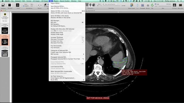 Performing Region of Interest ROI Segmentation with OsiriX 5 9 HD смотреть онлайн