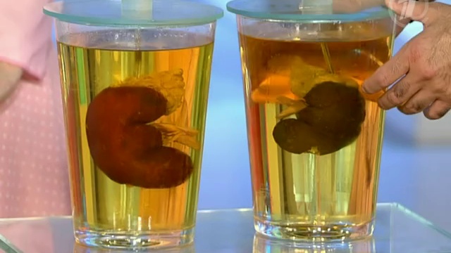 Гидронефроз. Как уберечь почки от водянки смотреть онлайн