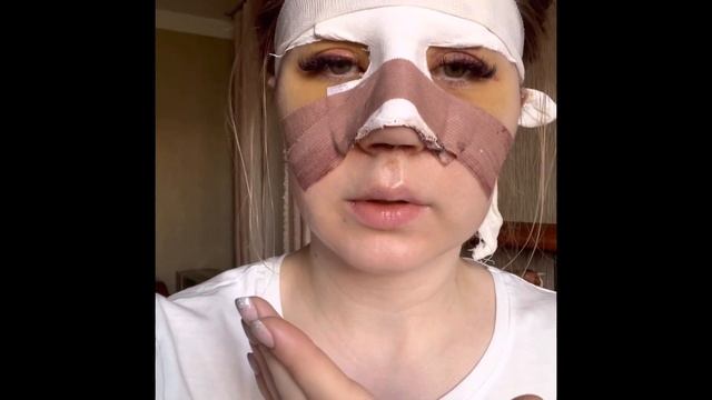 Моя ринопластика.Как это было.Дагестан.Махачкала.Клинника Панацея. смотреть онлайн