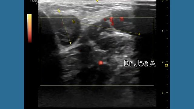 Cervical lymphadenitis or inflammation of neck lymph nodes- infection- ultrasound and Doppler video смотреть онлайн