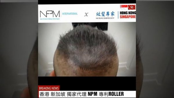 【NPM紋髮專家】香港紋髮際線專門店-仿真毛囊 脫髮 紋髮際線| 紋頭皮