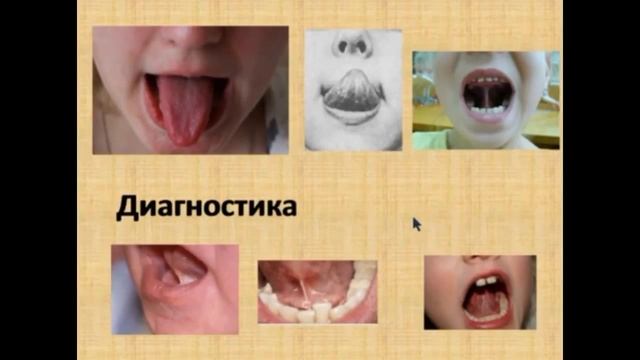 Короткая уздечка языка Когда нужно подрезать смотреть онлайн