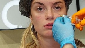 0.3 мл филлера на скулы