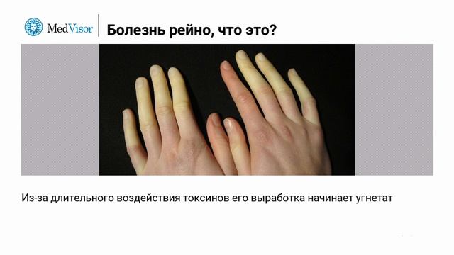 Связь между болезнью Рейно и здоровьем кишечника смотреть онлайн