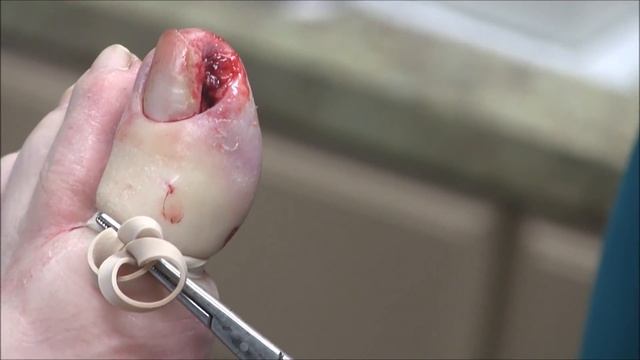 Infected Ingrown Toenail Removal With Pyogenic Granuloma
