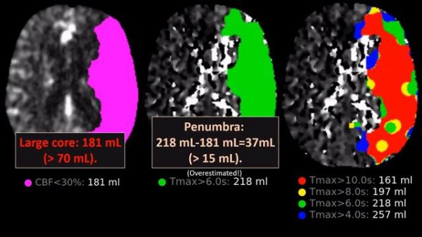 Perfusion CT made easy - everything you always wanted to know about PCT in acute ischemic stroke.