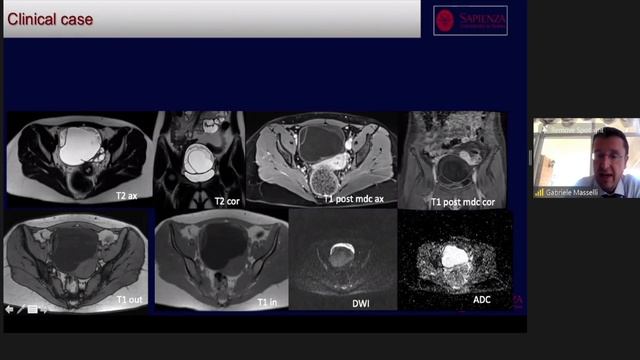 Oncological Imaging: Practical Approach - "Mimics of Malignancy: Andexal' by Dr Gabriele Masselli смотреть онлайн