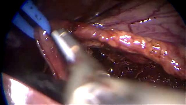 Лапароскопическая декомпрессия чревного ствола. смотреть онлайн