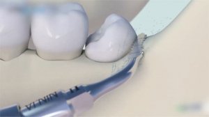 Удаление зуба в Перми. Удаление зуба с помощью ультразвука.