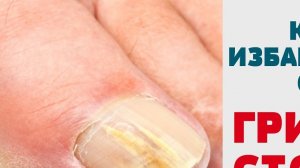 КАК ЛЕЧИТЬ ГРИБОК КОЖИ (СТОПЫ) Избавиться от грибка ногтей Запущенный грибок стопы