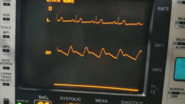 Monitor Datascope 3000 medicion смотреть онлайн