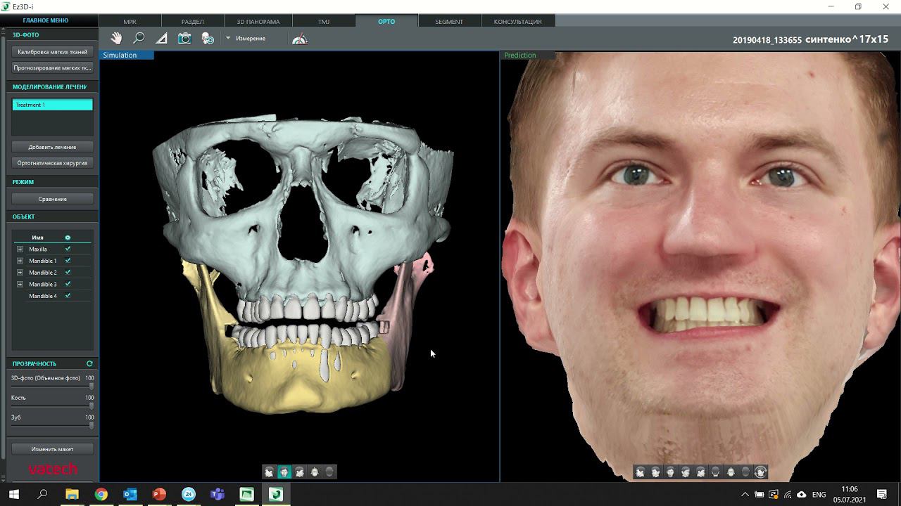 Ортогнатическая хирургия в программе Ez3D-i смотреть онлайн